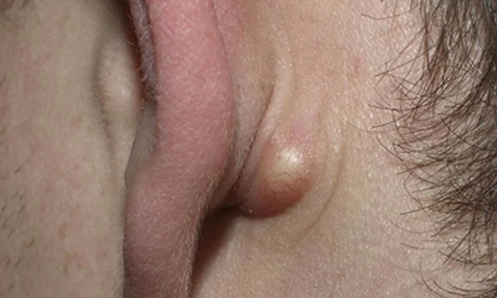 Τι σημαίνει για την υγεία το εξόγκωμα στο λαιμό ή πίσω από το αυτί